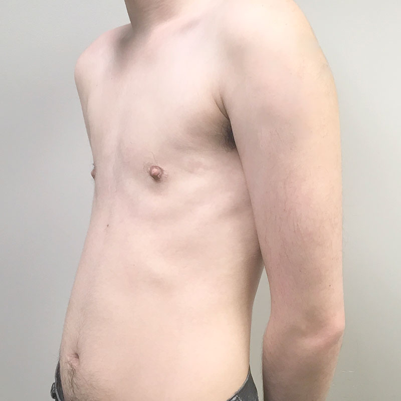 Female To Male Top Surgery 03