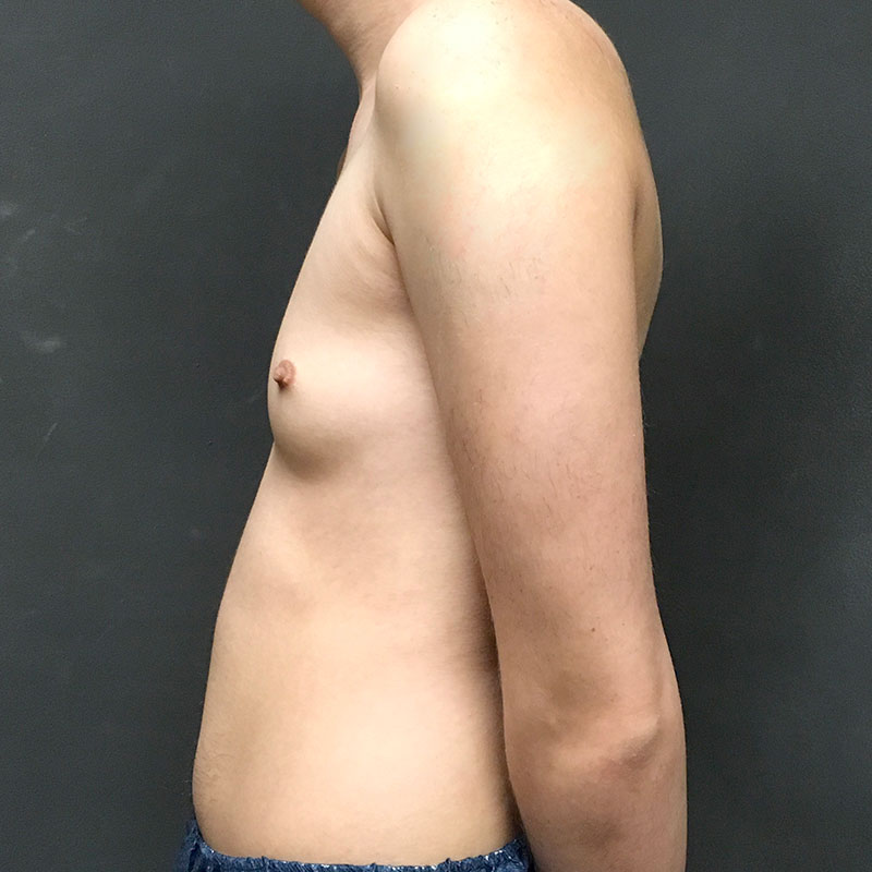 Female To Male Top Surgery 05