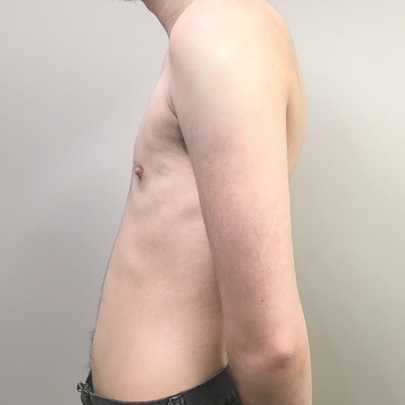 Female To Male Top Surgery 05