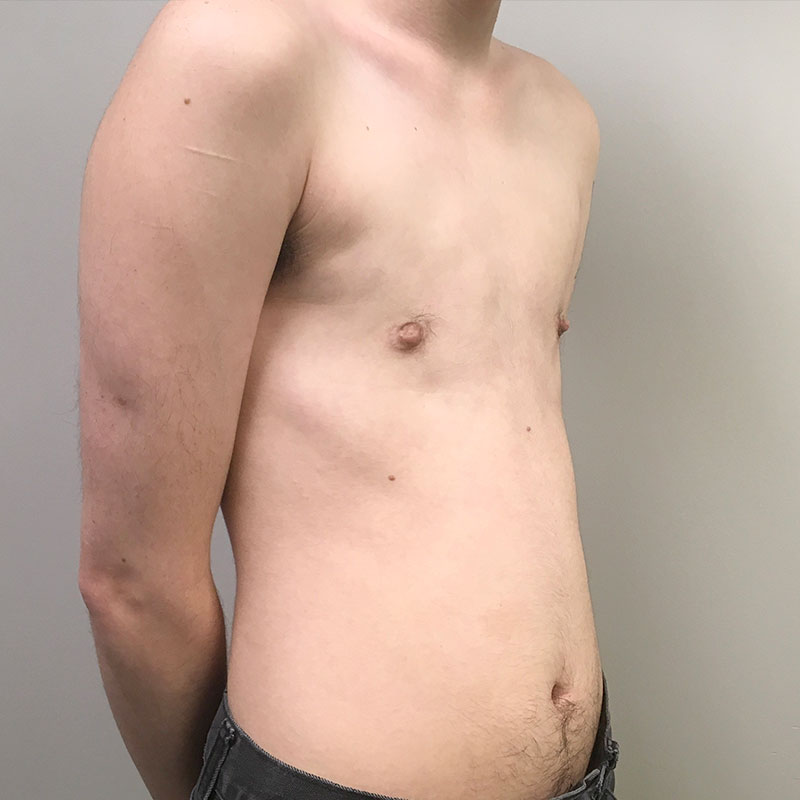 Female To Male Top Surgery 07