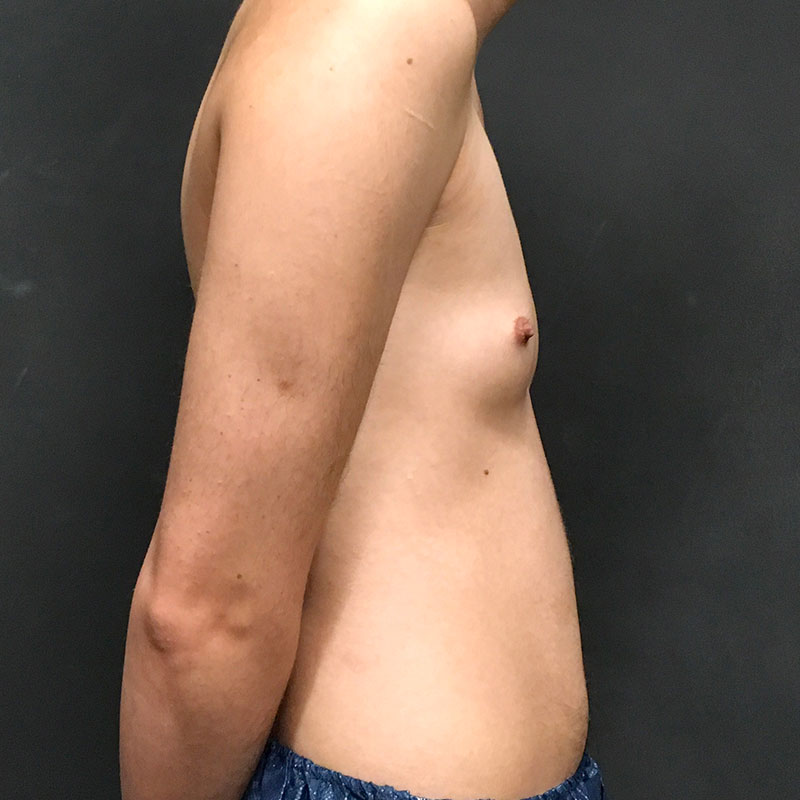 Female To Male Top Surgery 09