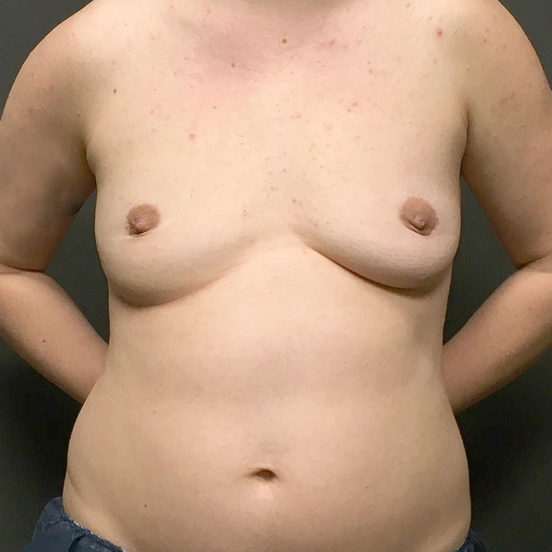 Female To Male Top Surgery 01