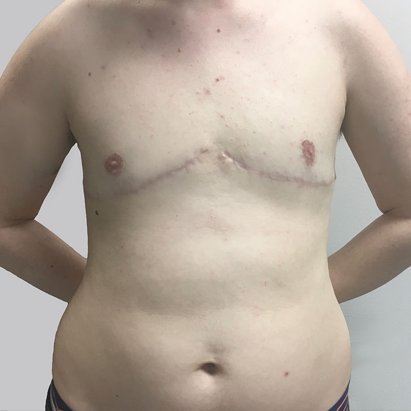 Female To Male Top Surgery 58