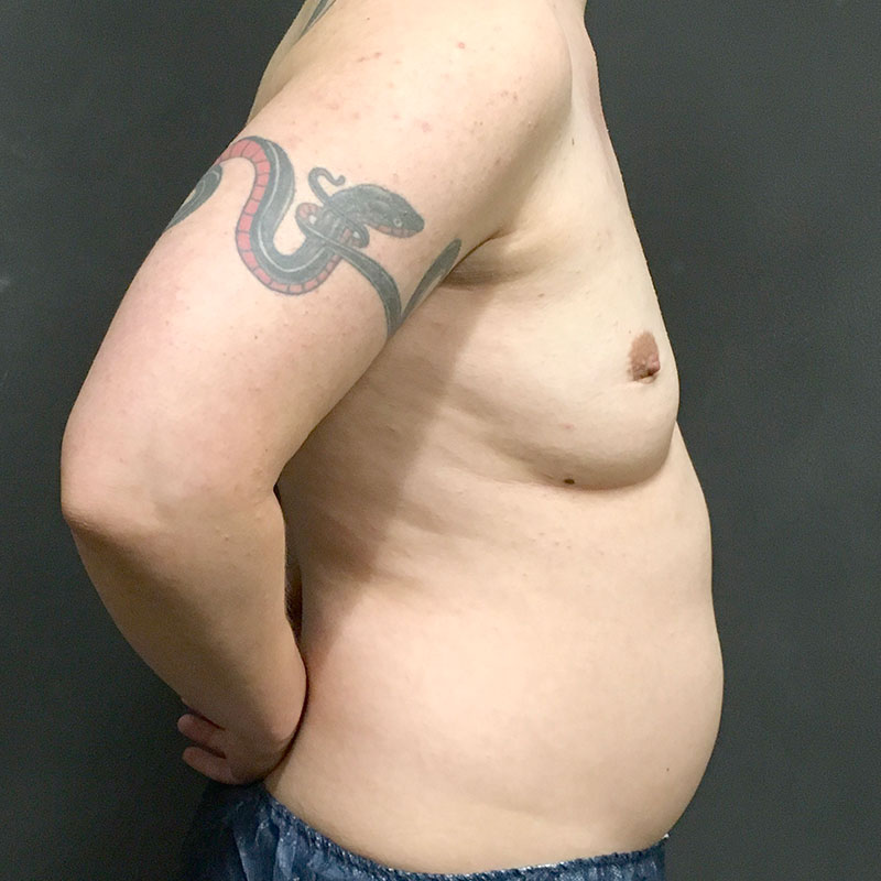 Female To Male Top Surgery 05