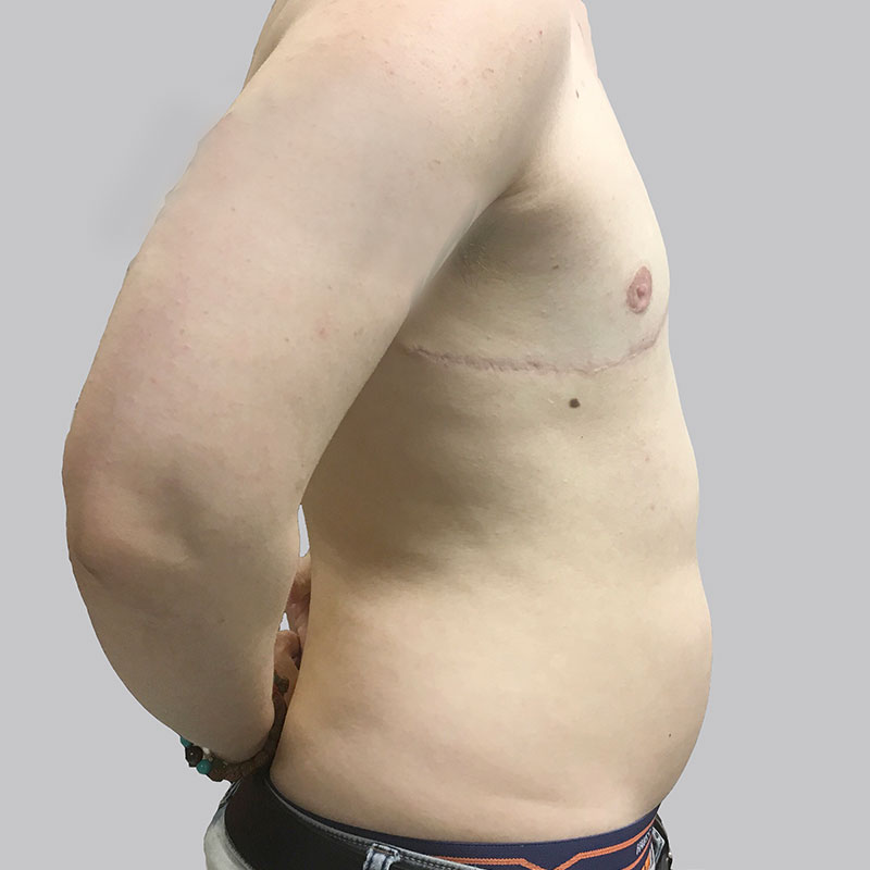 Female To Male Top Surgery 05