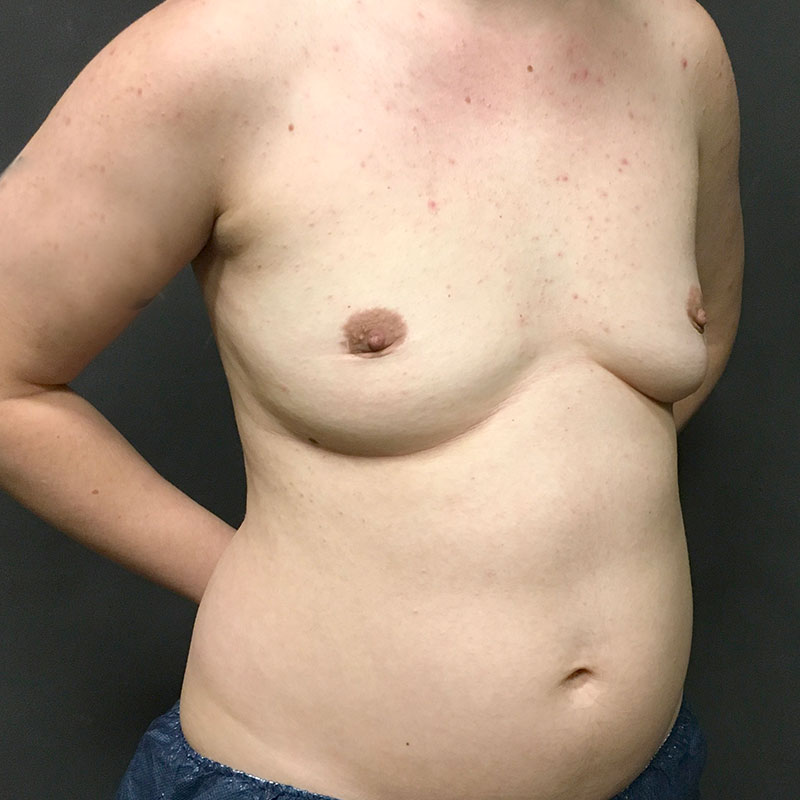 Female To Male Top Surgery 07