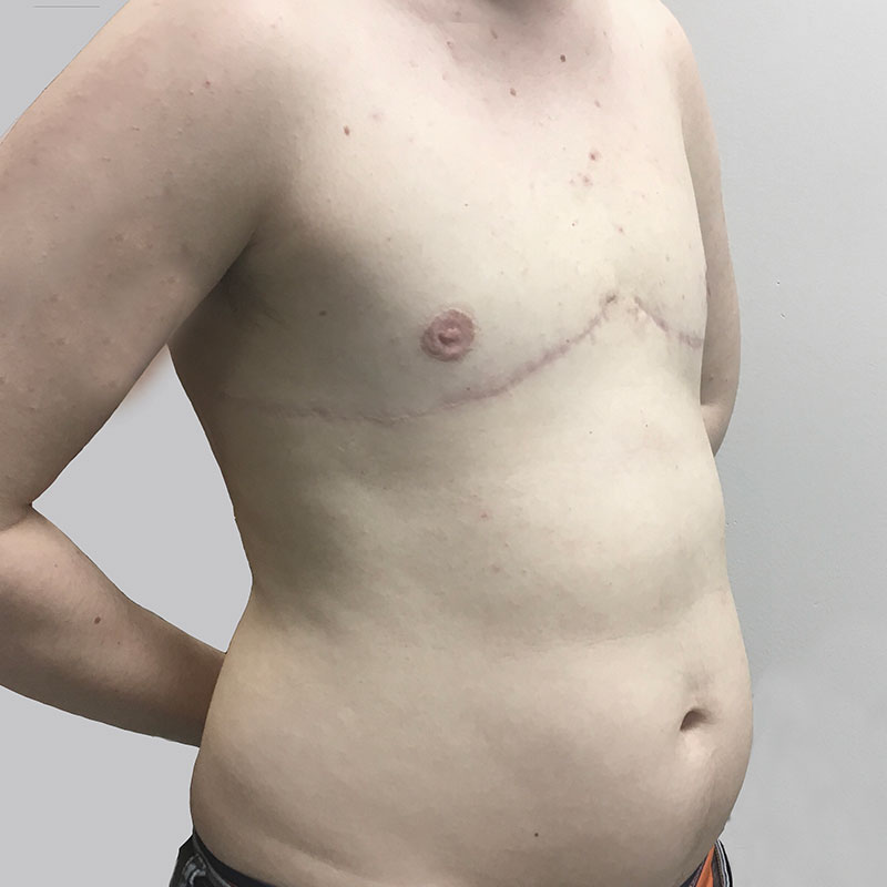 Female To Male Top Surgery 07