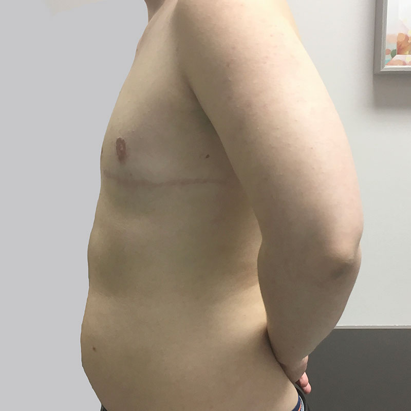 Female To Male Top Surgery 09