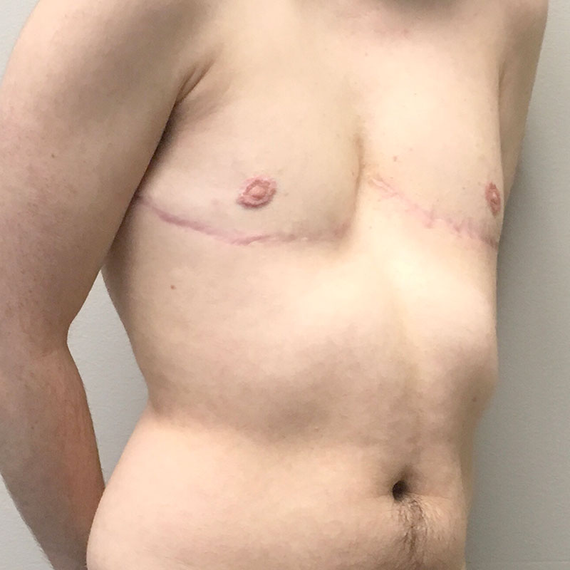 Female To Male Top Surgery 07