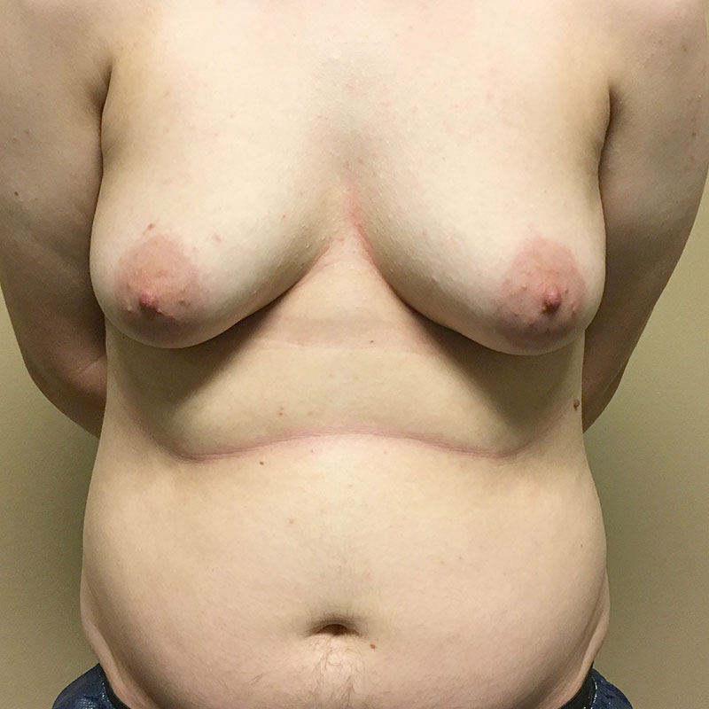 Female To Male Top Surgery 01