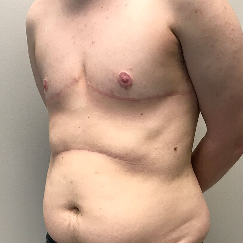 Female To Male Top Surgery 03