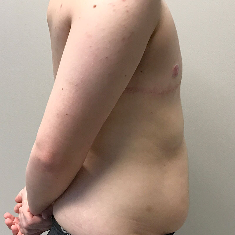 Female To Male Top Surgery 05