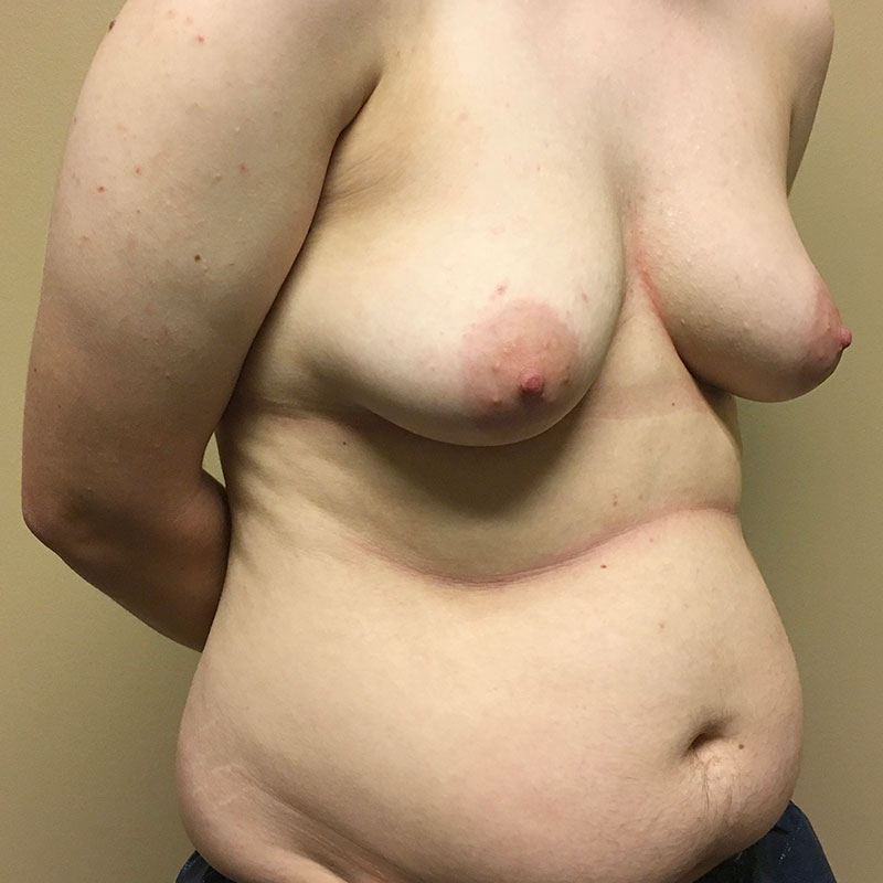 Female To Male Top Surgery 07