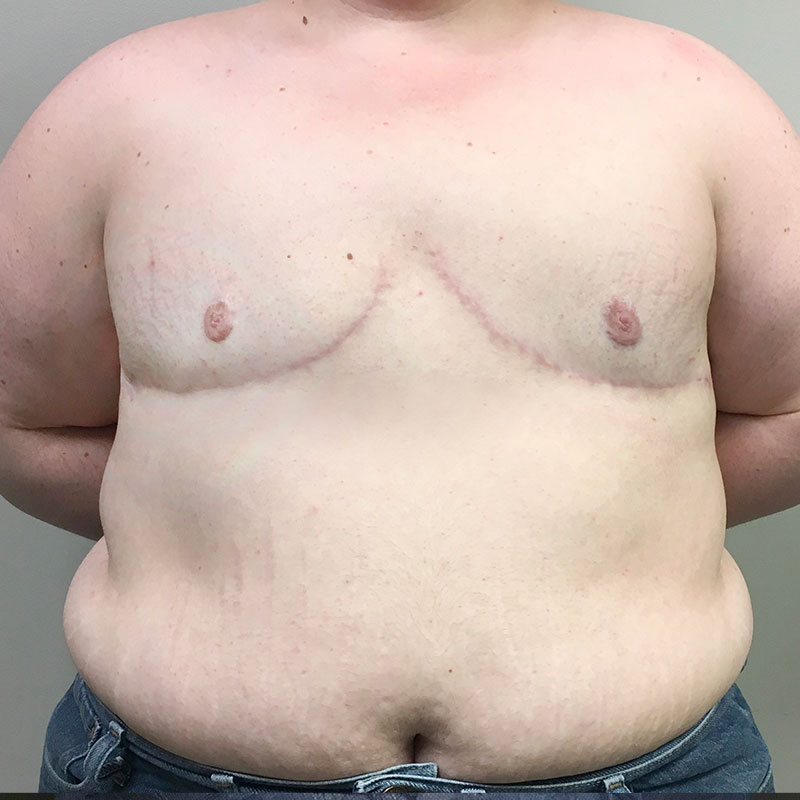 Female To Male Top Surgery 62