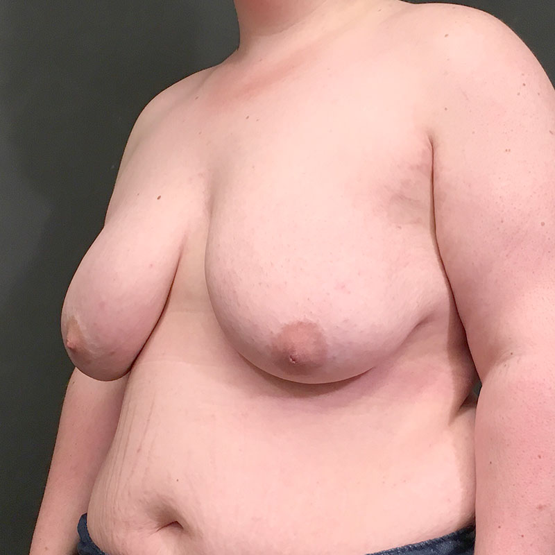 Female To Male Top Surgery 03