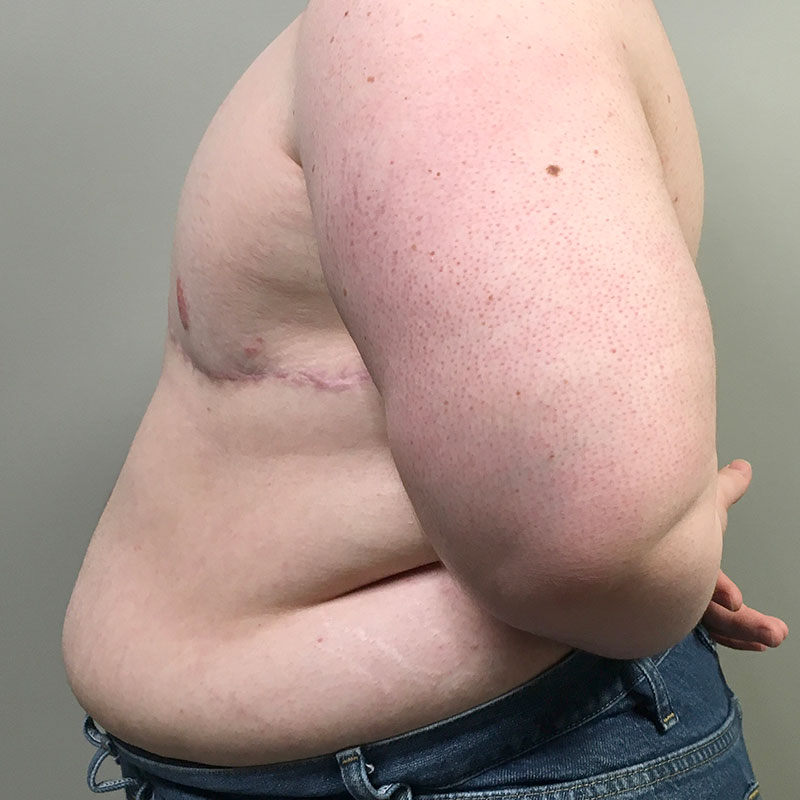 Female To Male Top Surgery 05