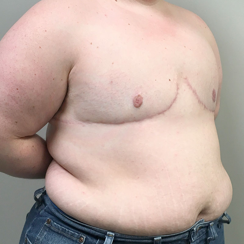 Female To Male Top Surgery 07