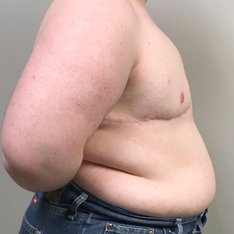 Female To Male Top Surgery 09