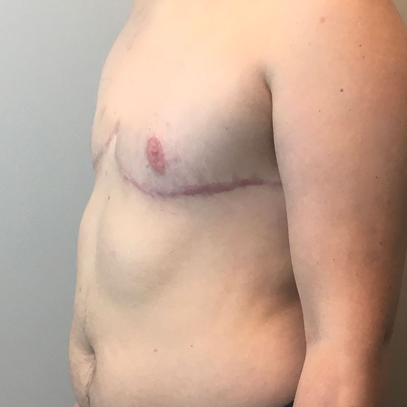 Female To Male Top Surgery 03