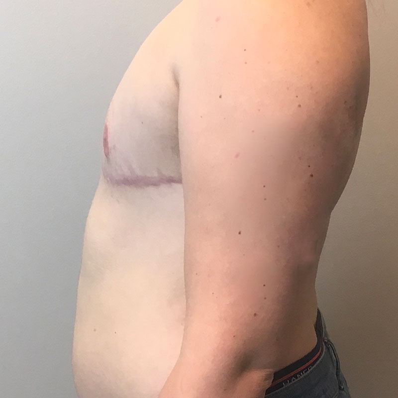 Female To Male Top Surgery 05