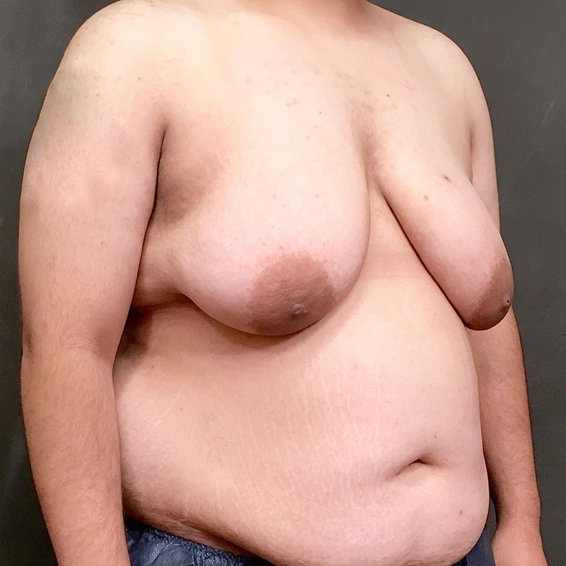 Female To Male Top Surgery 07