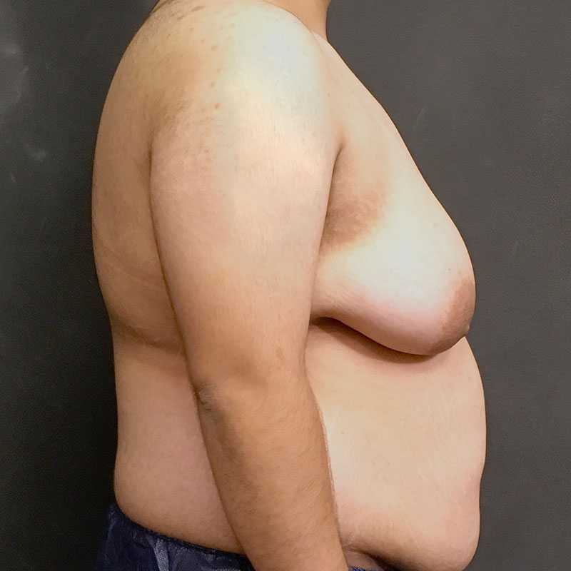 Female To Male Top Surgery 09