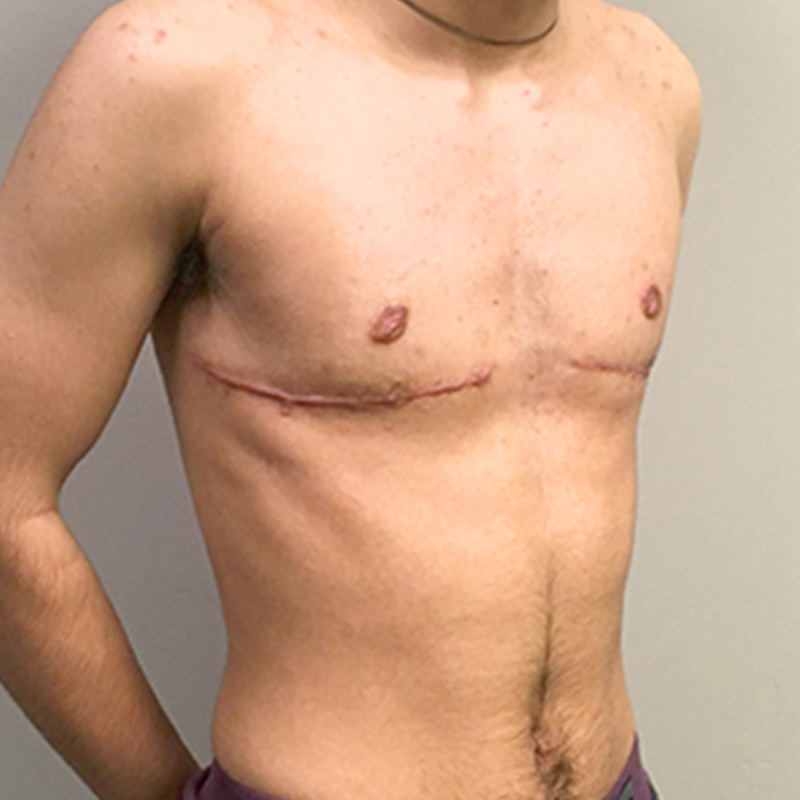 Female To Male Top Surgery 05