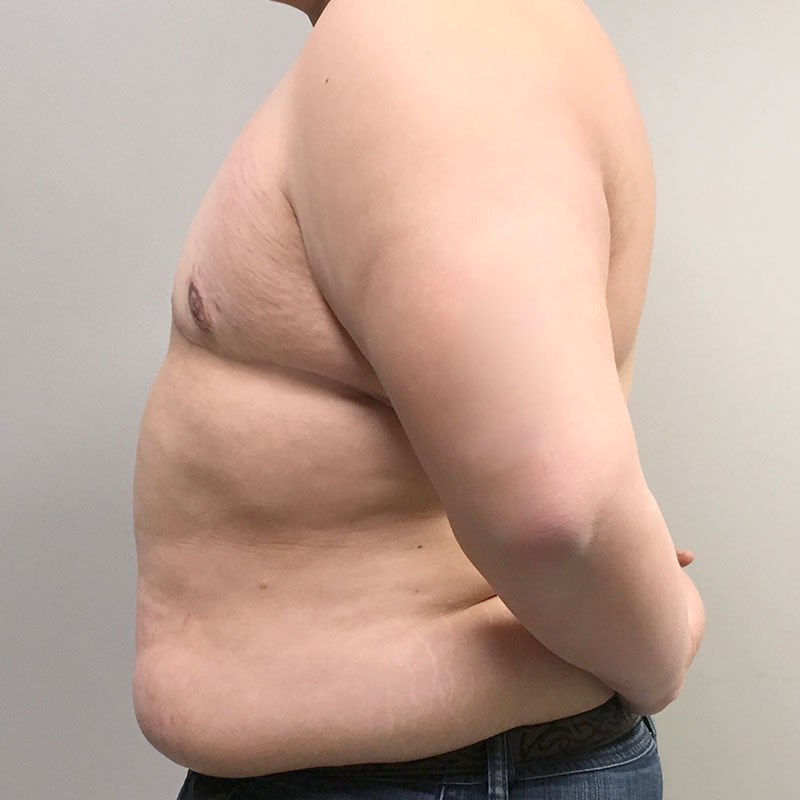 Female To Male Top Surgery 05