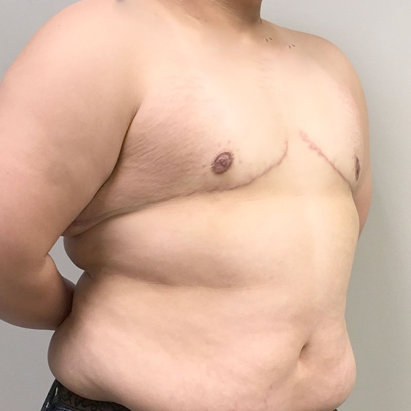 Female To Male Top Surgery 07