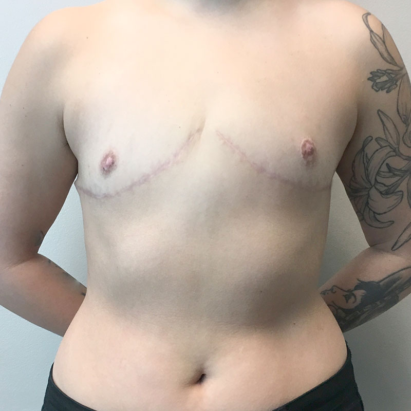 Female To Male Top Surgery 67