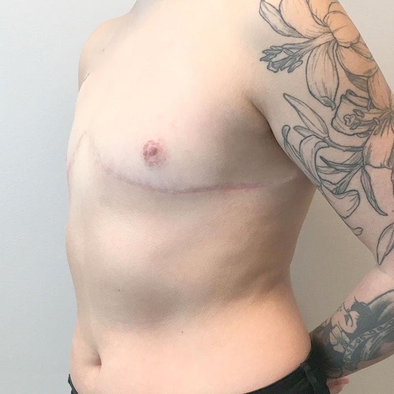 Female To Male Top Surgery 03