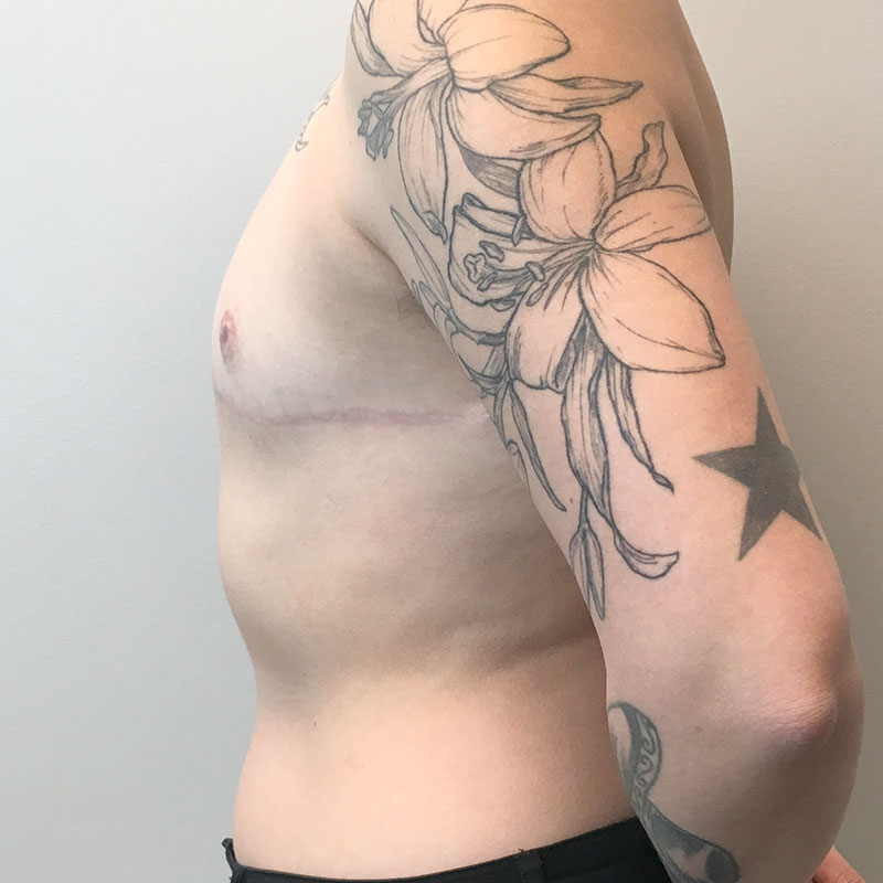 Female To Male Top Surgery 05