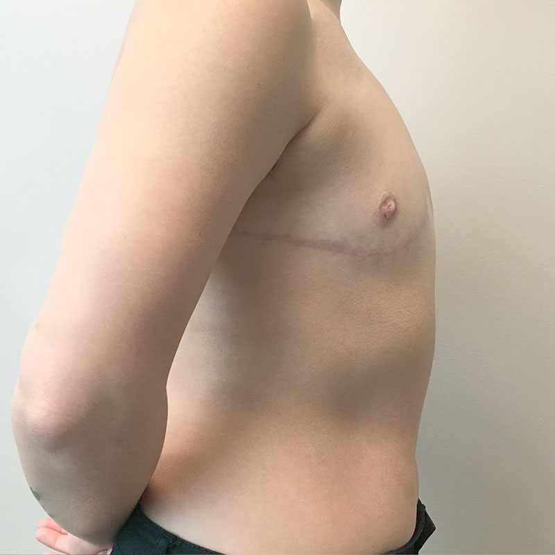 Female To Male Top Surgery 09