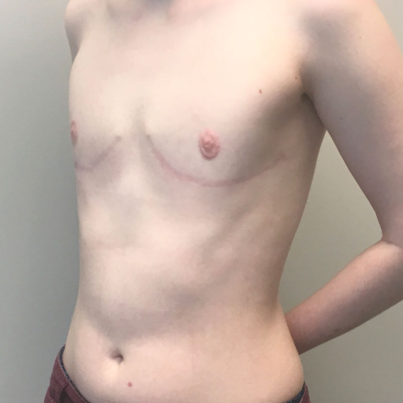 Female To Male Top Surgery 03