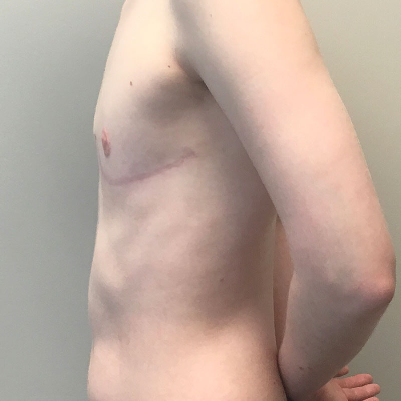 Female To Male Top Surgery 05