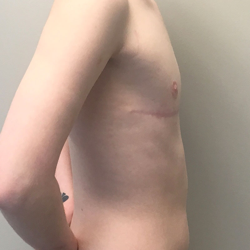 Female To Male Top Surgery 09