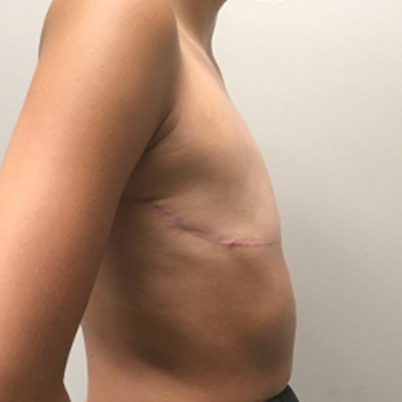 Female To Male Top Surgery 05