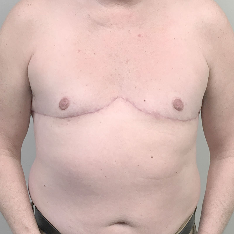 Female To Male Top Surgery 70