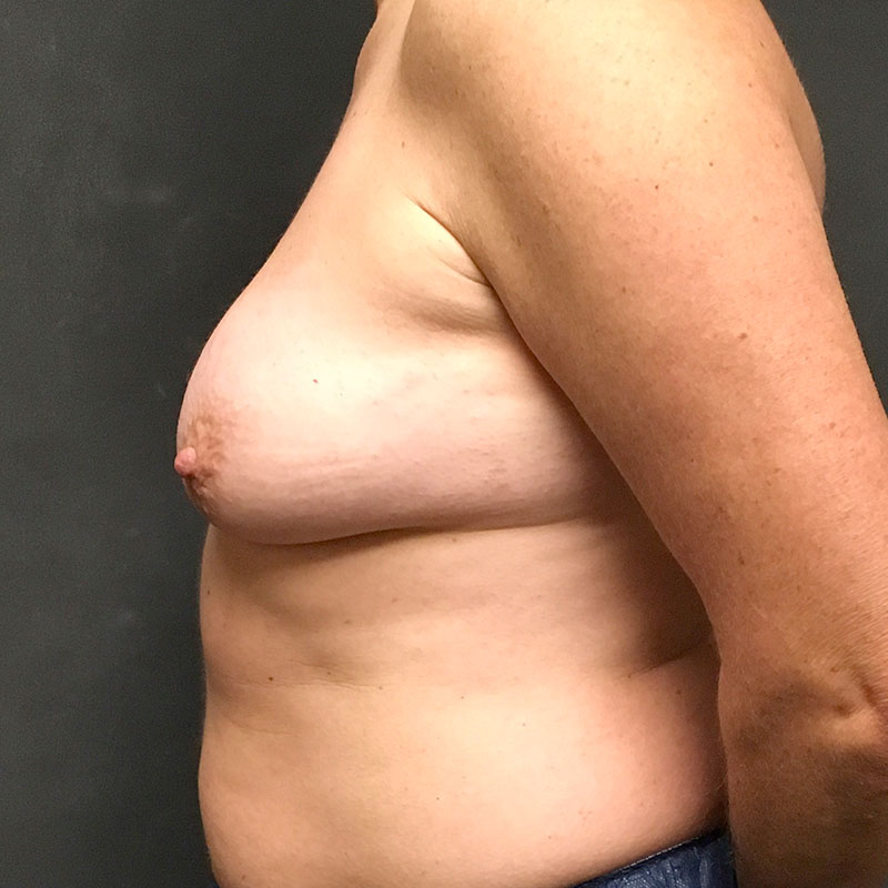 Female To Male Top Surgery 03