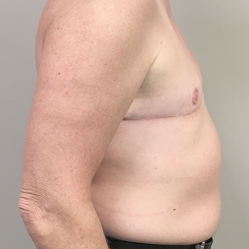 Female To Male Top Surgery 05