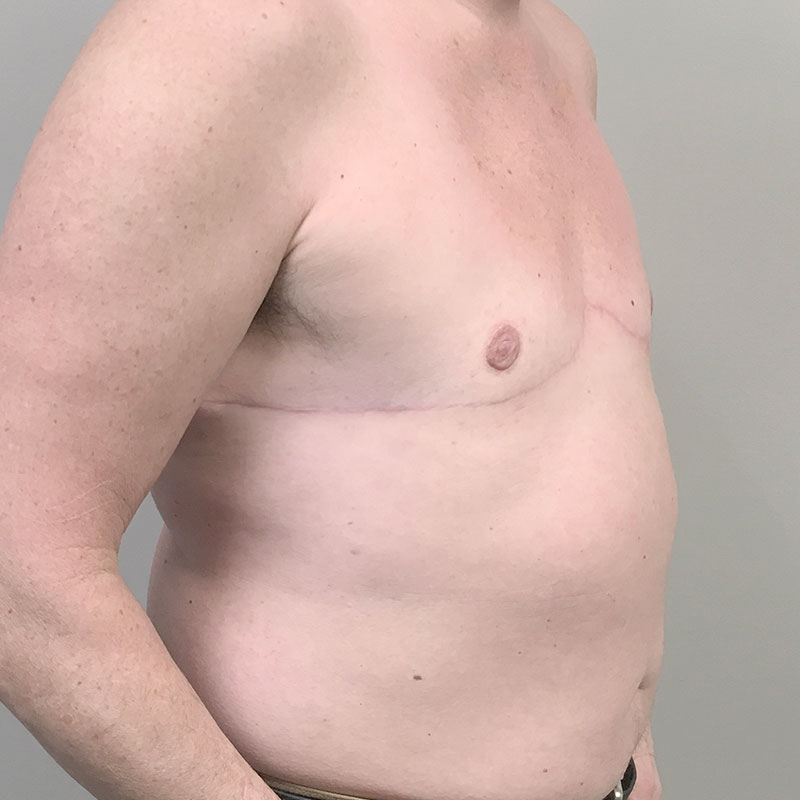 Female To Male Top Surgery 07