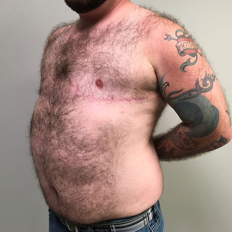 Female To Male Top Surgery 03