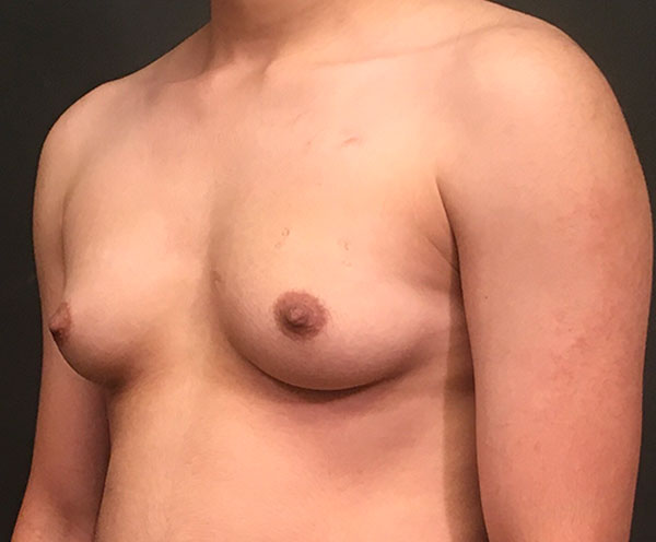 Female To Male Top Surgery 03