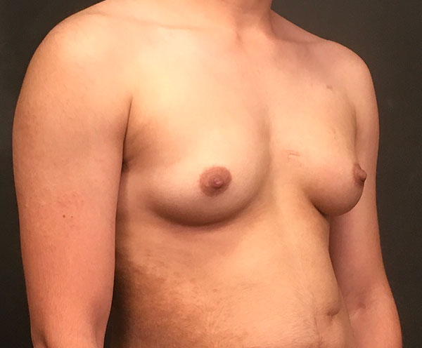 Female To Male Top Surgery 05