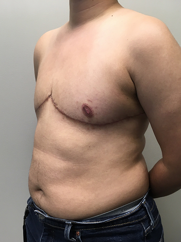 Female To Male Top Surgery 03