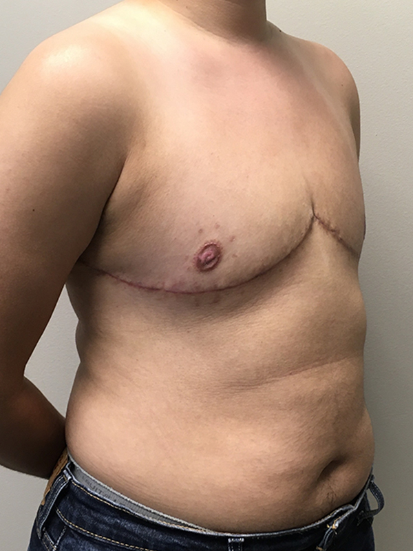 Female To Male Top Surgery 05