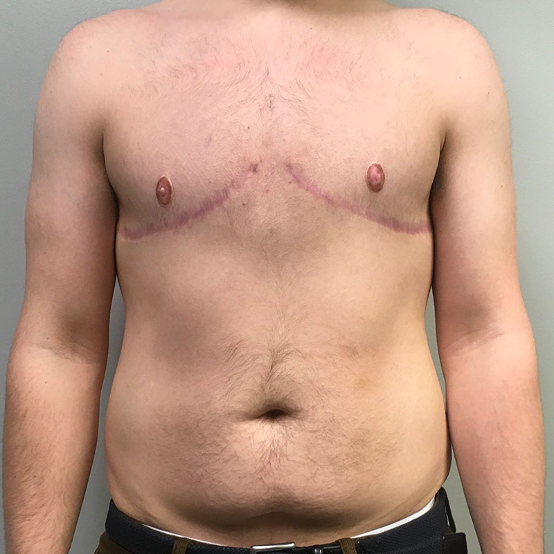 Female To Male Top Surgery 76