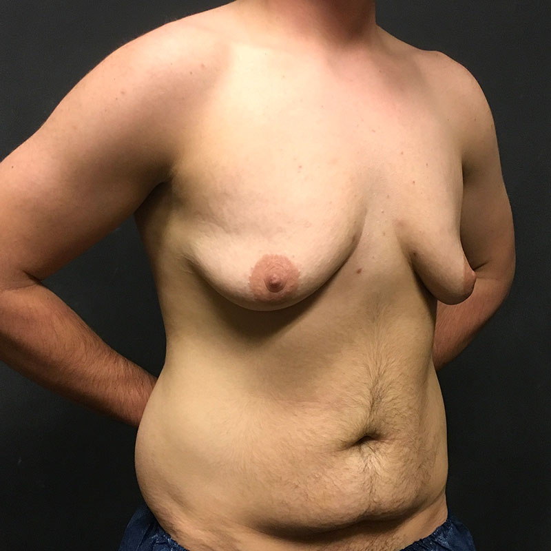 Female To Male Top Surgery 05