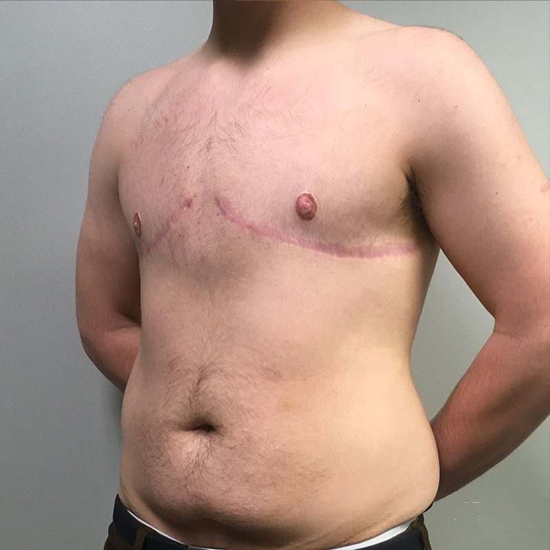 Female To Male Top Surgery 05