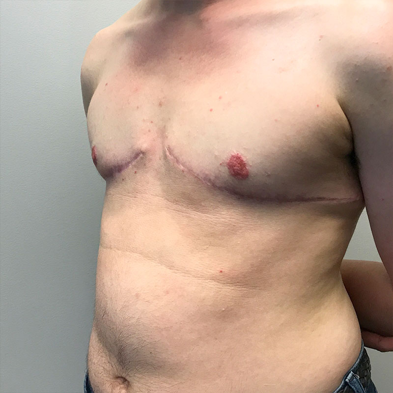 Female To Male Top Surgery 03